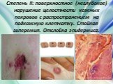 Степень II: поверхностное (неглубокое) нарушение целостности кожных покровов с распространением на подкожную клетчатку. Стойкая гиперемия. Отслойка эпидермиса.