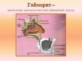 Гайморит – воспаление верхнечелюстной гайморовой пазухи