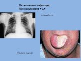 Осложнения инфекции, обусловленной VZV. пневмония Некроз тканей
