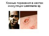 Кожные поражения в местах инокуляции Leishmania sp.