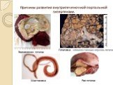Причины развития внутрипеченочной портальной гипертензии. Эхинококкоз печени. Гепатома - злокачественная опухоль печени. Рак печени Шистосома