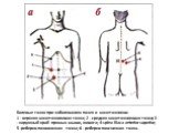 Болевые точки при заболеваниях почек и мочеточников: 1 - верхняя мочеточниковая точка; 2 - средняя мочеточниковая точка; 3 - наружный край прямых мыши, живота; 4-spina iliaca anterior superior; 5 -реберно-позвоночная точка; 6 - реберно-поясничная точка.