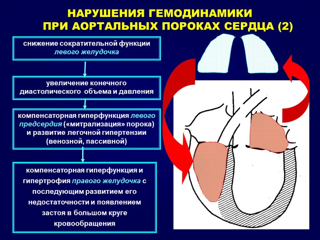 Митральный аортальный стеноз. Нарушение гемодинамики при пороках сердца. Аортальный стеноз гемодинамика схема. Приобретенные пороки сердца схема гемодинамики. Гемодинамика при пороках аортальных пороках сердца.