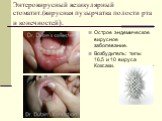 Энтеровирусный везикулярный стоматит.(вирусная пузырчатка полости рта и конечностей). Острое эндемическое вирусное заболевание. Возбудитель: типы 16,5 и 10 вируса Коксаки.