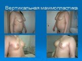 Вертикальная маммопластика