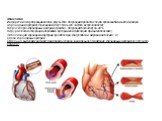 Этиология Инфаркт миокарда развивается в результате обтурации просвета сосуда кровоснабжающего миокард (коронарная артерия). Причинами могут стать (по частоте встречаемости): Атеросклероз коронарных артерий (тромбоз, обтурация бляшкой) 93-98 % Хирургическая обтурация (перевязка артерии или диссекция