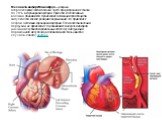 Механизм инфаркта миокарда — разрыв атеросклеротической бляшки, часто при умеренном стенозе до 70% в коронарной артерии. При этом коллагеновые волокна обнажаются, происходит активация тромбоцитов, запускается каскад реакций свертывания, что приводит к острой окклюзии коронарной артерии. Если восстан