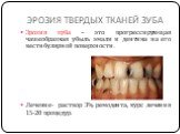 ЭРОЗИЯ ТВЕРДЫХ ТКАНЕЙ ЗУБА. Эрозия зуба – это прогрессирующая чашеобразная убыль эмали и дентина на его вестибулярной поверхности. Лечение- раствор 3% ремодента, курс лечения 15-20 процедур.