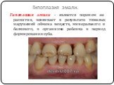 Гипоплазия эмали. Гипоплазия эмали - является пороком ее развития, возникает в результате тяжелых нарушений обмена веществ, минерального и белкового, в организме ребенка в период формирования зуба.