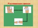 Растяжения связок