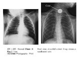 400 × 400 - Normal Chest X Ray 3 Year Old Child Photographic Print. Front view of a child's chest X-ray shows a swallowed coin.