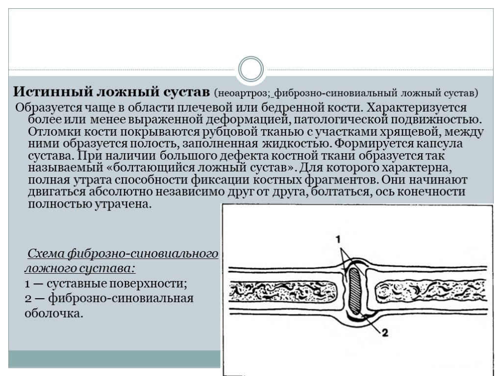 Ложный сустав. Истинный ложный сустав. Гипертрофический ложный сустав. Фиброзный ложный сустав.