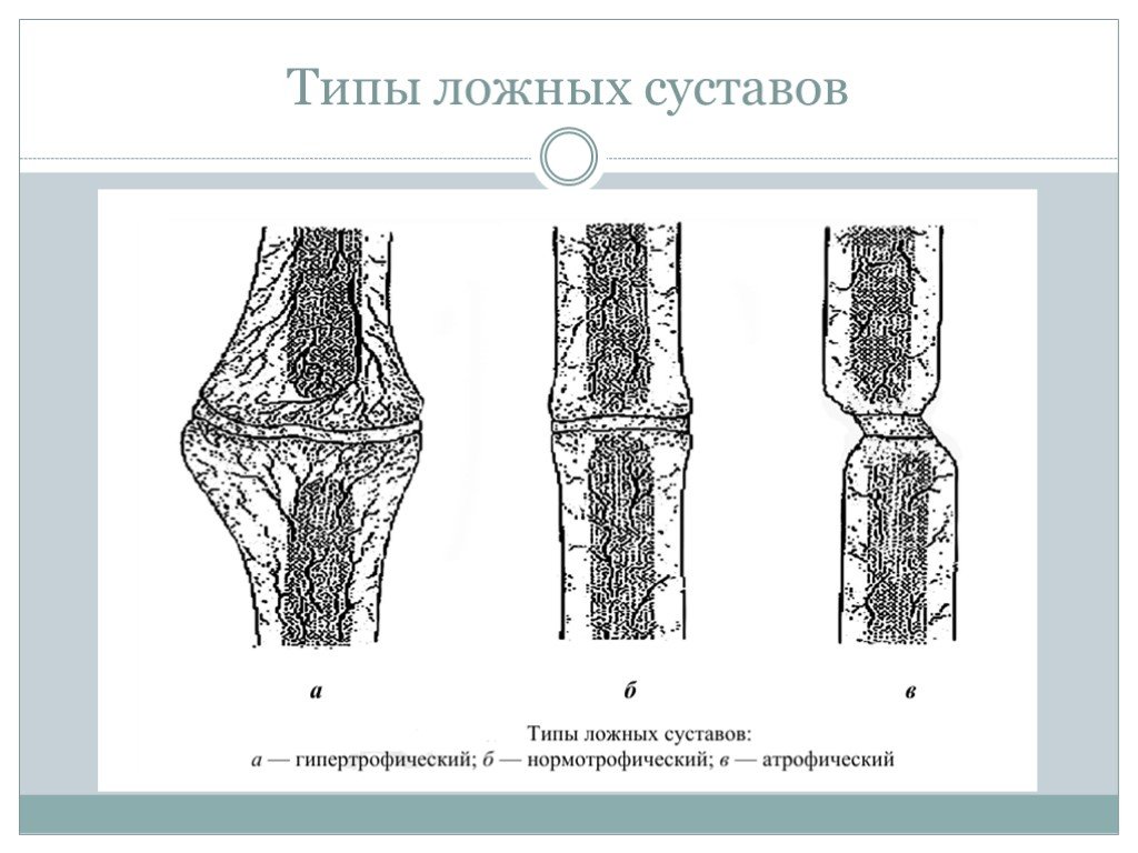 Развитие суставов. Ложный сустав большеберцовой кости. Нормотрофический ложный сустав. Ложный сустав большеберцовой кости рентген. Ложные суставы трубчатых костей.