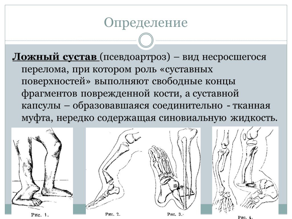 Ложный сустав презентация