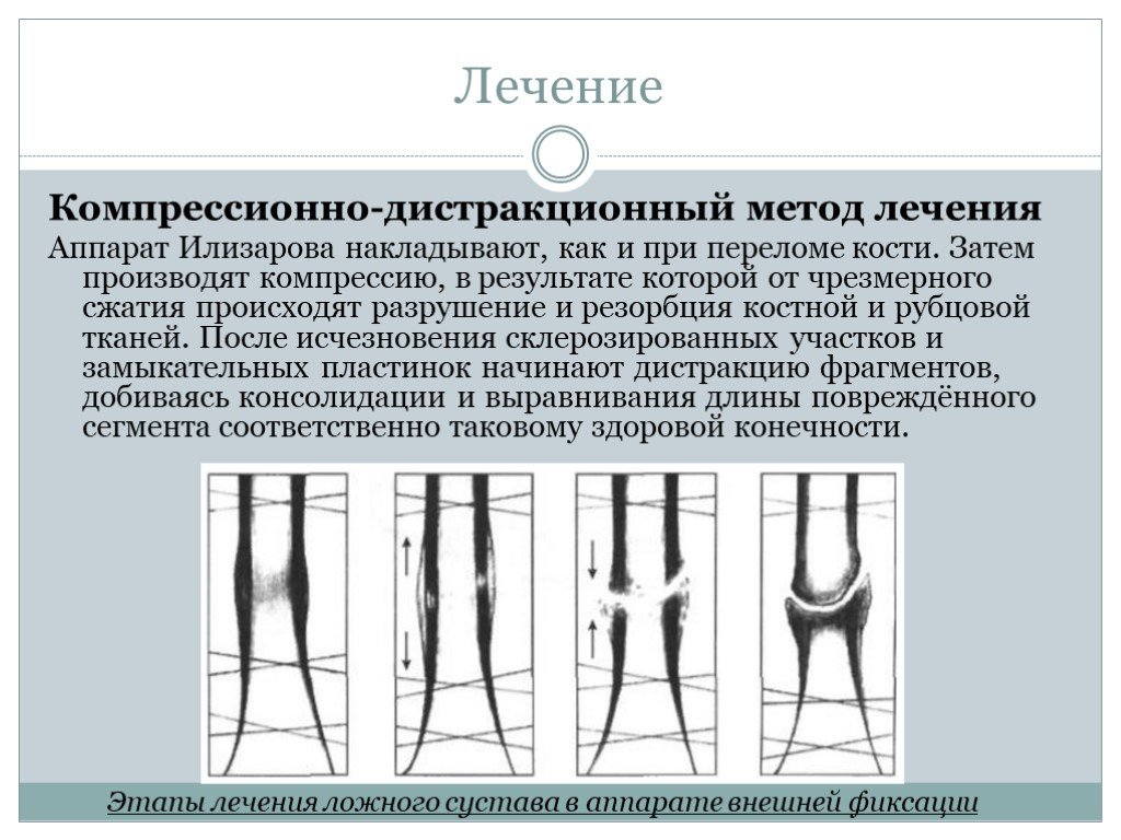 Лечение трещины кости