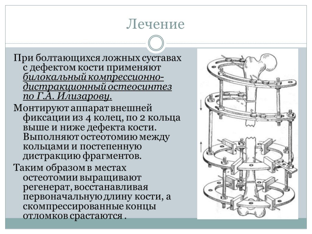 Аппарат илизарова презентация