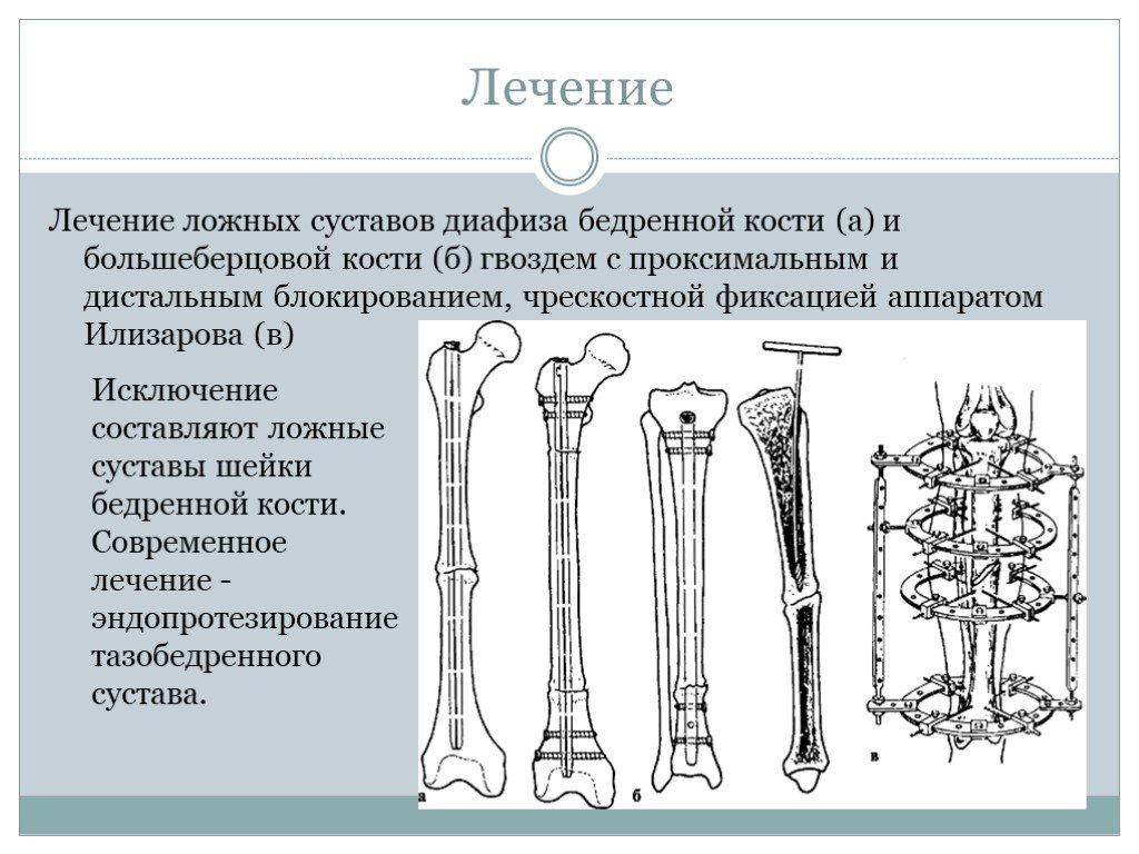 Ложный сустав презентация