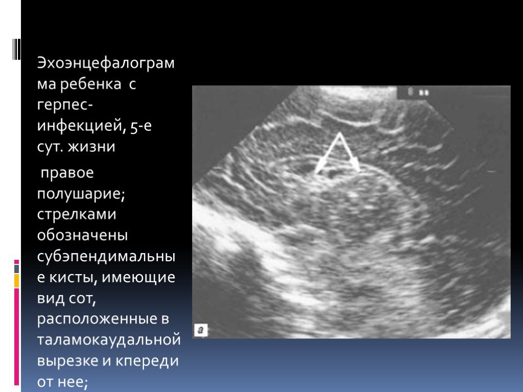 Каудоталамическая вырезка. Субэпендимальная киста на УЗИ. Субэпендимальные кисты у новорожденного. Каудоталамическая вырезка киста.