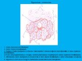 Крупозная пневмония. 1. Зона красной гепатизации; 2. Зона серой гепатизации; 3. Нежные нити фибрина и обилие лейкоцитов в альвеолярном пространстве в зоне красной гепатизации; 4.Резко инъецированные сосуды межальвеолярных перегородок в зоне красной гепатизации; 5. Отложение масс фибрина в альвеолах 