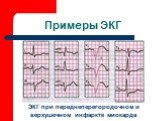 Примеры ЭКГ. ЭКГ при переднеперегородочном и верхушечном инфаркте миокарда