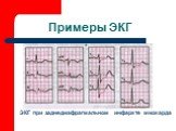 ЭКГ при заднедиафрагмальном инфаркте миокарда