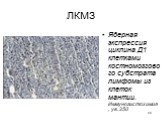 Ядерная экспрессия циклина Д1 клетками костномозгового субстрата лимфомы из клеток мантии. Иммуногистохимия, ув. 250