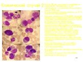 Клинический случай 2. Б-й Ш.,39 лет, поступил с жалобами на повышение температуры до 40 наблюдается в отделении гематологии с апреля 2006 года В миелограмме обнаруживалось до 31 % атипичных лимфоцитов Биопсия лимфоузла 12.05.2006: фрагмент лимфоузла а паранодальной клетчаткой с наличием пролиферации