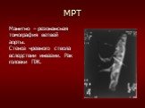 МРТ. Манитно – резонансная томография ветвей аорты. Стеноз чревного ствола вследствии инвазии. Рак головки ПЖ.