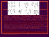Схематическое изображение электрографиче¬ских элементов, встречающихся при эпилепсии. / — пики (острия): / — двуфазный пик, 2 — трехфазный пик, 3 — монофазный отрицательный пик; II — острая волна; /// — медленная волна; IV— комплекс «острая волна — медленная вол¬на»; V — ритм «волна — пик 3 кол./сек