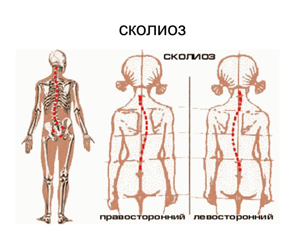 В каких плоскостях бывает ротация сколиоза