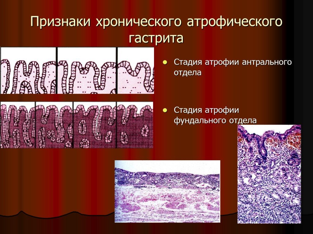 Атрофический гастрит симптомы. Хронический атрофический гастрит фазы. Стадии и степени хронического атрофического гастрита. Степени хронического атрофического гастрита. Хронический атрофический гастрит стадии.