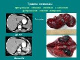 Центральная гематома селезенки с наличием артериальной ложной аневризмы. 7-е сутки