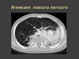 Рентгеновская диагностика пороков развития лёгких у детей Слайд: 10