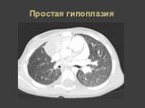 Рентгеновская диагностика пороков развития лёгких у детей Слайд: 13