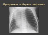 Рентгеновская диагностика пороков развития лёгких у детей Слайд: 20