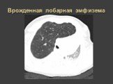 Рентгеновская диагностика пороков развития лёгких у детей Слайд: 21