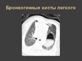 Рентгеновская диагностика пороков развития лёгких у детей Слайд: 25