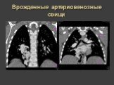 Рентгеновская диагностика пороков развития лёгких у детей Слайд: 27