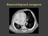 Рентгеновская диагностика пороков развития лёгких у детей Слайд: 31