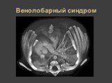 Рентгеновская диагностика пороков развития лёгких у детей Слайд: 32