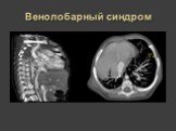 Рентгеновская диагностика пороков развития лёгких у детей Слайд: 34