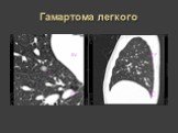 Рентгеновская диагностика пороков развития лёгких у детей Слайд: 37