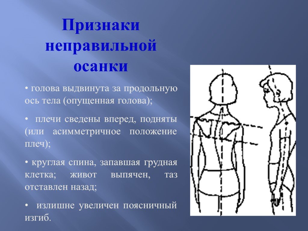 Положение плеч. Неправильная осанка. • Голова выдвинута за продольную ось тела(опущенная голова).. Осанка с выдвинутой вперед головой. Ось правильной осанки.