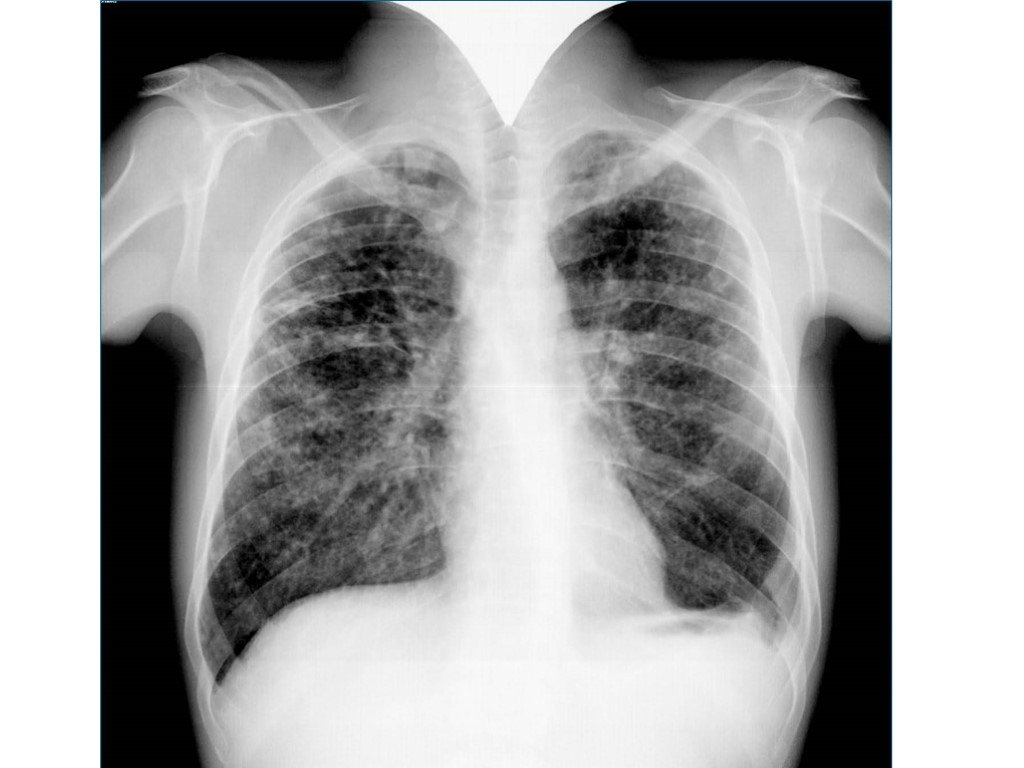 Туберкулез легкого рентгенограмма. Подострый диссеминированный туберкулез рентген. Милиарный туберкулез флюорография. Диссеминированный туберкулез легких снимок. Рентген снимок диссеминированный туберкулез.