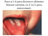 Язык в 1-й день болезни обложен белым налетом, со 2 по 5 день малиновый.