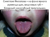 Симптом Филатова – на фоне яркого румянца щек, вишневых губ – бледный носогубный треугольник.
