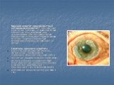 Краевой кератит (поверхностный катаральный кератит)– ограниченное воспаление роговицы, развивающееся как осложнение конъюнктивита или дакриоцистита. Для предотвращения осложнений необходимо медикаментозное лечение. Возможно помутнение периферии роговицы, не влияющее на зрение. Симптомы краевого кера