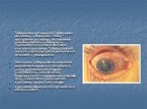 Туберкулезный кератит (туберкулез роговицы, туберкулез глаза) – воспаление роговицы, вызываемое микобактериями туберкулеза. Проявляется мутными желтыми очагами в роговице. Туберкулезный кератит характеризуется длительным течением с рецидивами. Симптомы туберкулезного кератита ощущение инородного тел