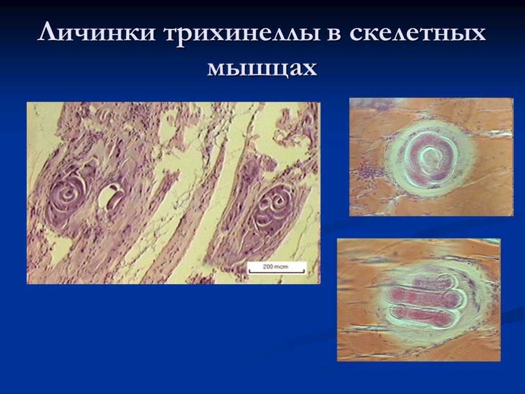 Инкапсулированные личинки трихинеллы в мышцах рисунок с обозначениями