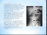 Рентгенологическое исследование остается основным специальным методом диагностики острой кишечной непроходимости. Оно должно быть проведено при малейшем подозрении на это состояние. Как правило, сначала выполняют обзорную рентгеноскопию (-график») брюшной полос­ти. При этом могут быть выявлены следу